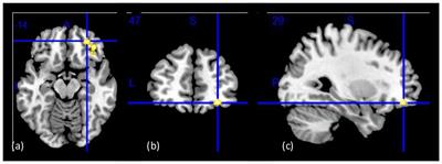 Reduced Orbitofrontal Gray Matter Concentration as a Marker of Premorbid Childhood Trauma in Cocaine Use Disorder
